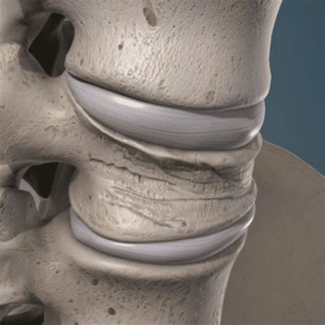 Compression Fractures Of The Spine Florida Surgery Consultants