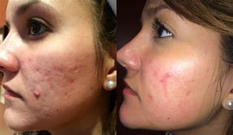 It nourishes skin with essential fatty acids, and. Acne Scar Therapy : Omaha Med Spa
