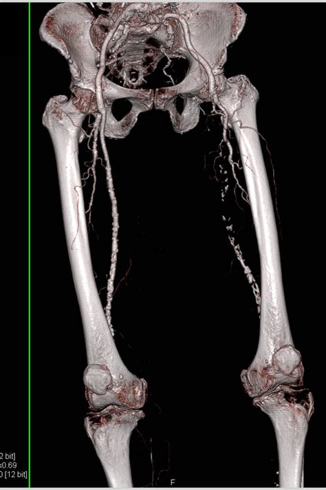 Occluded Left Superficial Femoral Artery Sfa Vascular Case Studies