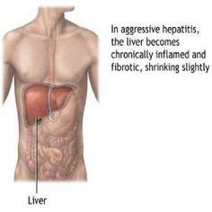 24 Latest End Stage Liver Disease ideas | liver disease, liver, liver ...