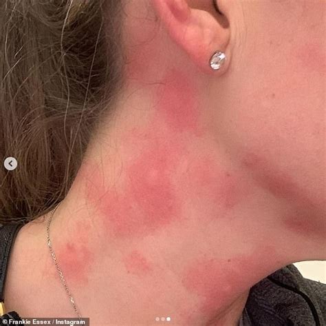 Frankie Essex Reveals Her Horrific Hot And Itchy Neck Rash Following