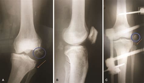 Revista Brasileira De Ortopedia Osteochondral Segond Fracture