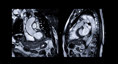 Cardiac Mri Lakeland Florida Radiology And Imaging Specialists