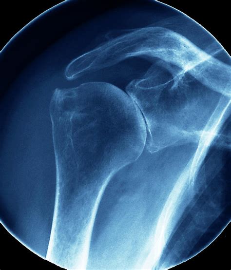 Arthritic Shoulder Photograph By Zephyrscience Photo Library Fine