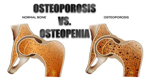 Osteoporosis Vs Osteopenia Whats The Difference El Paso Tx