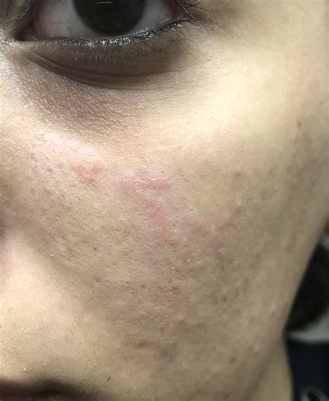 Help Ice Pick Scarring Worse After Fractora What Can I Do Pics