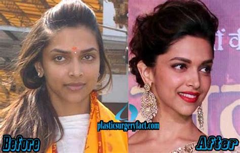 Deepika Padukone Plastic Surgery Before And After Plastic Surgery Facts