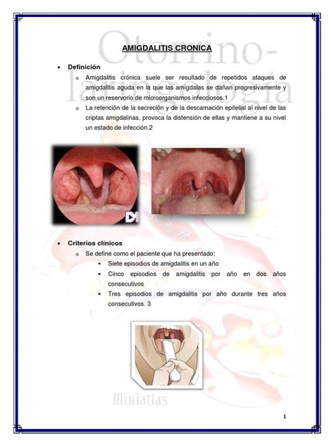 Amigdalitis Cronica Estreptococo Infección