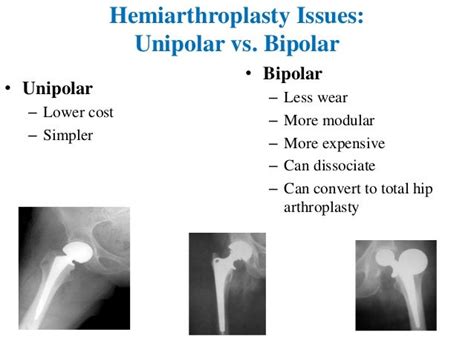 Hemiarthroplasty Of Hip Joint