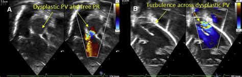 A Apical View Of Dysplastic Pulmonary Valve Pv And Free