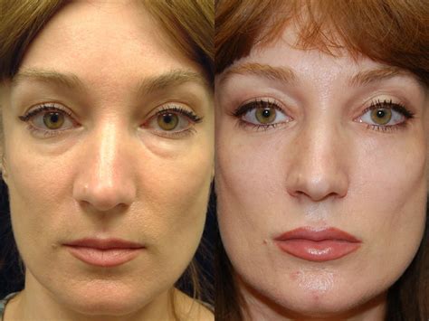 Before And After Tear Trough Fillers Cosmeticplastic Surgery