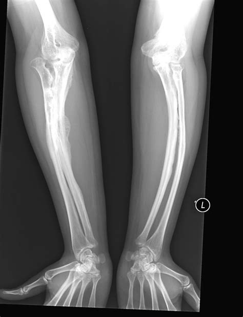 Osteogenesis Imperfecta Leg Buyxraysonline