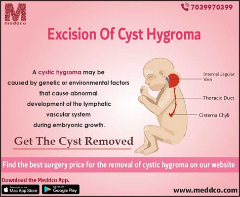 Cystic hygroma in pregnancy
