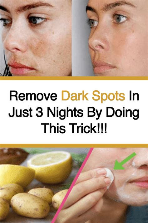 remove dark spots in just 3 nights by doing this trick brown spots on face remove dark spots