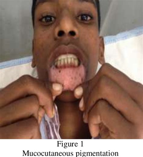 Figure 1 From PEUTZ JEGHERS SYNDROME PRESENTING WITH ACUTE INTESTINAL