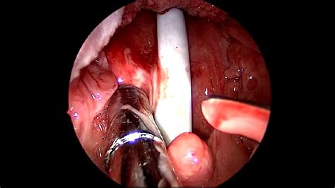 Trans Oral Drainage Of Retropharyngeal Abscess Youtube