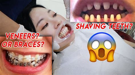 Im Finally Straightening My Teeth In Korea Invisalign Vs Braces Vs