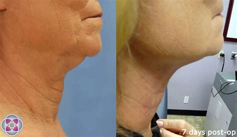 Necktite Non Surgical Jowl And Neck Tightening