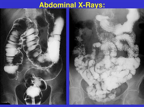 Ppt Abdominal X Ray Powerpoint Presentation Free Download Id2983195