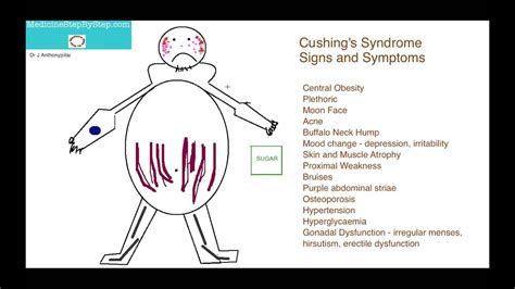 Cushings Syndrome Signs And Symptoms Part 2 Youtube