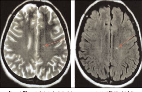 Pdf Characteristic Analysis Of White Matter Lesions In Migraine