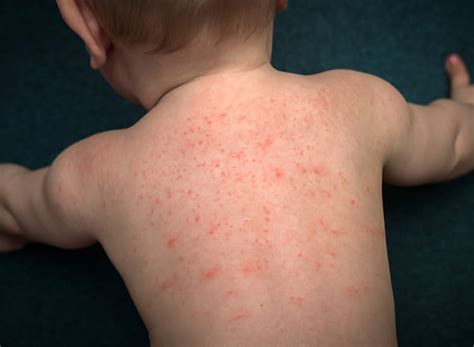 Allergic reaction rash baby is a sign for you. Baby Rashes: Types, Symptoms & More