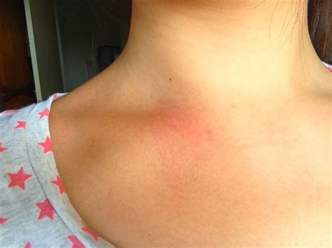 Related Keywords And Suggestions For Swollen Clavicle