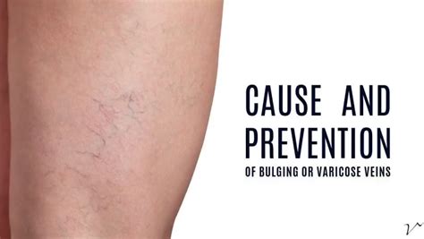 Cause And Prevention Of Bulging Or Varicose Veins Artofit