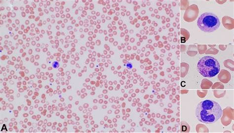 Scielo Brasil Myelodysplastic Syndrome In A 30 Year Old Man With