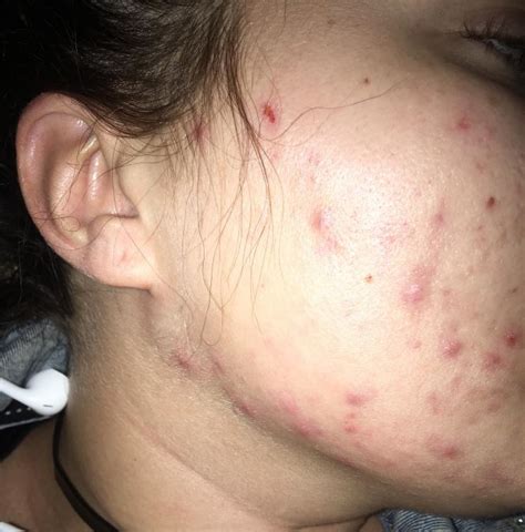 Hard Itchy Painful Bumps Around Jawline General Acne Discussion