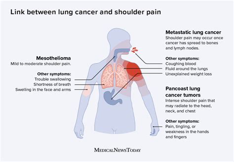 Lung Cancer And Shoulder Pain Whats The Link