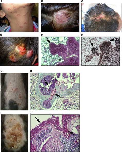 Frontiers Skin Immunity To Dermatophytes From Experimental Infection