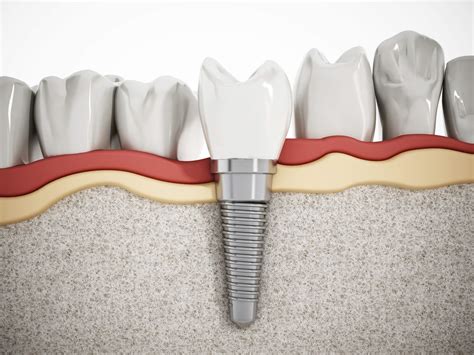 How Long Do Dental Implants Last On Average Dr Mehta Dds