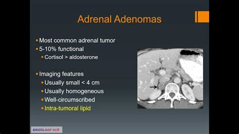 Adrenal Adenomas Radiology Lecture Types Ct Mri Features Absolute