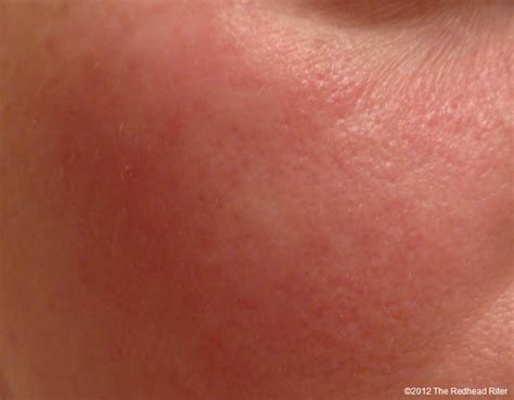 Red Bumps On Face Allergic Reaction S What Is The Most Viewed Music