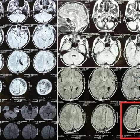 Brain Mri Findings Shows Left Cerebral Hemi Atrophy With Thinning Of