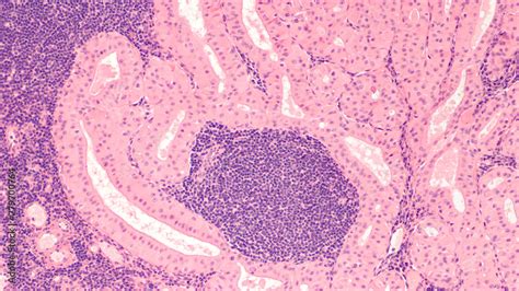 Microscopic Image Of A Warthins Tumor A Benign Tumor Of The Salivary