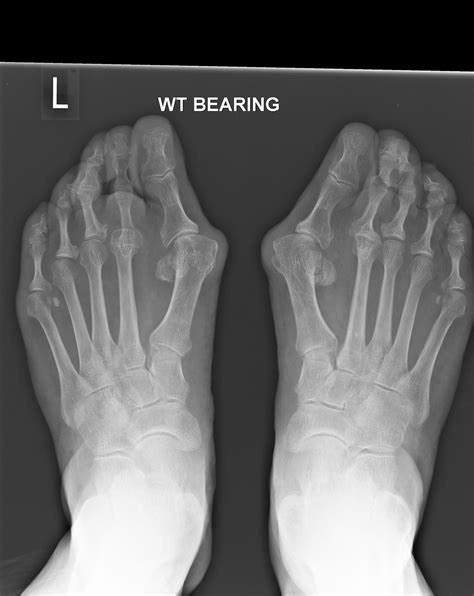 Patient Info About Forefoot Reconstruction Surgery