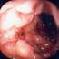 What Is The Appearance Of Duodenal Ulcers On Endoscopy