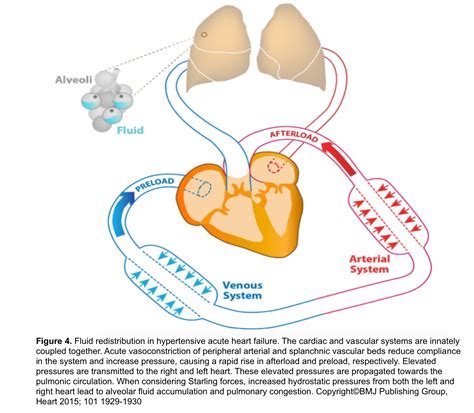 Pathophysiology Of Acute Cardiogenic Pulmonary Edema