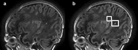 Automatic Detection Of Punctate White Matter Lesions Pwmls In An