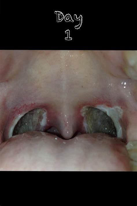 Tonsillectomy Day 1 Tonsillectomy