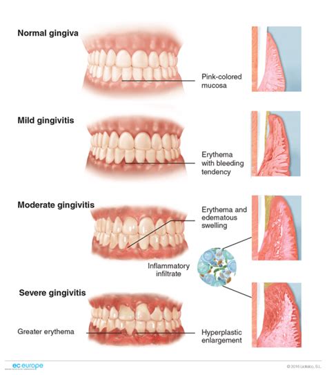 Gingivitis Classifications