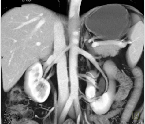 Duplicated Collecting System Left Kidney With An Incidental Left 1 Cm