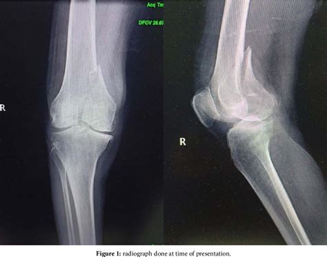 Figure From Case Report Of Surgical Treatment Of Spiral Fracture Of