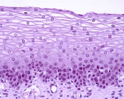 Epit Lio Escamoso Estratificado Imagem De Stock Imagem De Cervix Microscopia