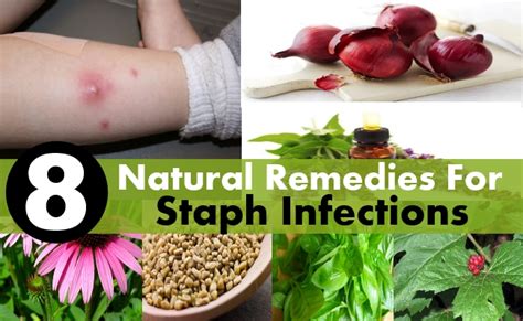 Natural Therapy For Staphylococcus Aureus Galleria