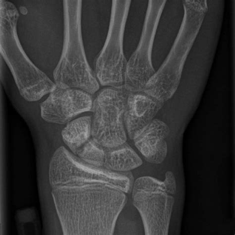 Radiograph Of The Left Wrist Shows Stress Fracture Of The Left Scaphoid