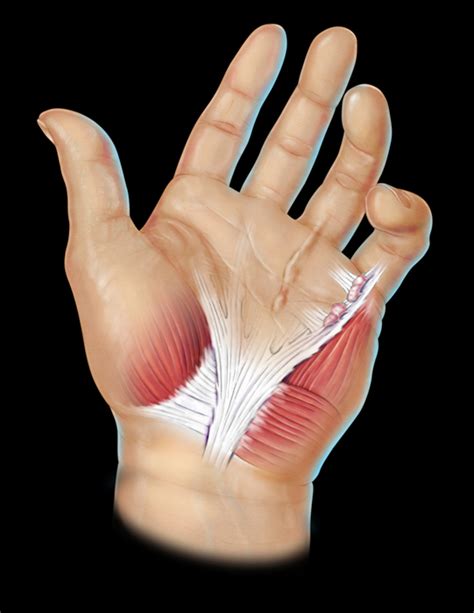 Dupuytrens Contracture Clark Medical Media