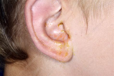 Outer Ear Infection Stock Image C0263280 Science Photo Library